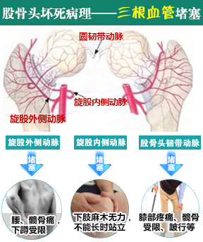 股骨头坏死的病理介绍